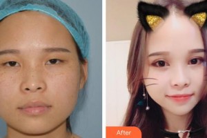 昆明華山眼科醫(yī)院汪志剛整形價(jià)格表附切開雙眼皮案例展示