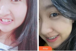 昆明醫(yī)科大學(xué)第二附屬醫(yī)院整形外科張景波整形價(jià)格表附齒隱形矯正案例展示