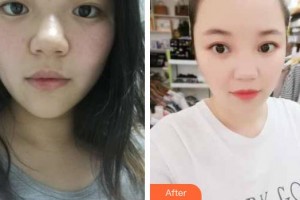 昆明愛(ài)爾眼科醫(yī)院黃廷剛整形價(jià)格表附眼部案例展示