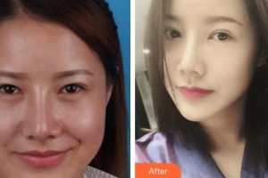 昆明華山眼科醫(yī)院范黎妮整形價(jià)格表附眼部綜合案例展示