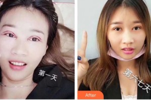 昆明愛(ài)爾眼科醫(yī)院楊建宇整形價(jià)格表附眼部綜合案例展示