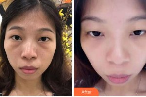 昆明華山眼科醫(yī)院謝伯林整形價(jià)格表附激光去眼袋案例展示