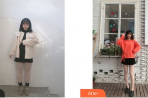 南寧天美醫(yī)學(xué)美容診所陳炳駿整形價格表附大腿吸脂案例展示