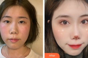 南寧科之美醫(yī)療美容診所陸大鵬整形價(jià)格表附眼部手術(shù)案例展示