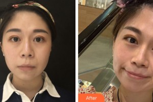 南寧思瑞醫(yī)療美容外科診所馬艷整形價(jià)格表附面部輪廓案例展示