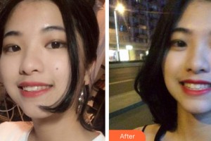 南寧天使口腔醫(yī)院李艷華整形價(jià)格表附牙齒矯正案例展示