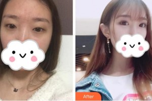 昆明愛(ài)爾眼科醫(yī)院程玉霞整形價(jià)格表附眼部綜合案例展示