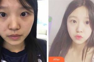 昆明普瑞眼科醫(yī)院宮樞政整形價(jià)格表附眼部綜合案例展示