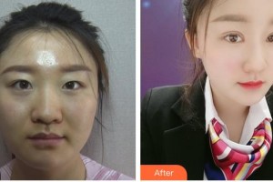 昆明普瑞眼科醫(yī)院袁援生整形價(jià)格表附定點(diǎn)雙眼皮案例展示