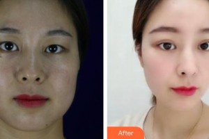 昆明普瑞眼科醫(yī)院秦秀芬整形價(jià)格表附上眼瞼去脂案例展示