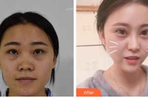 昆明普瑞眼科醫(yī)院邵彥明整形價(jià)格表附切開(kāi)雙眼皮例展示