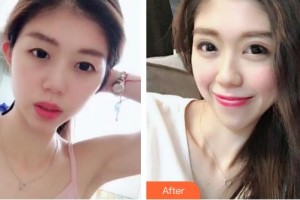 昆明普瑞眼科醫(yī)院趙青整形價(jià)格表附切開雙眼皮案例展示