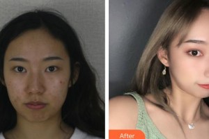 昆明普瑞眼科醫(yī)院雷鳴整形價(jià)格表附眼部綜合案例展示