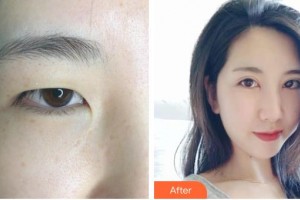 昆明普瑞眼科醫(yī)院錢婷整形價(jià)格表附眼部綜合案例展示