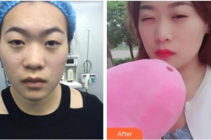 昆明普瑞眼科醫(yī)院袁湘華整形價(jià)格表附切開雙眼皮案例展示