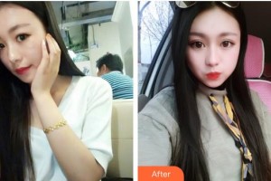 昆明普瑞眼科醫(yī)院張煜宸整形價(jià)格表附切開雙眼皮案例展示