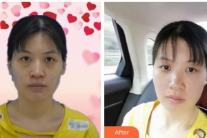 昆明康特森眼科醫(yī)院喬彤整形價(jià)格表附眼部綜合價(jià)格表