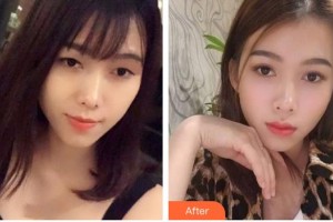 昆明愛爾眼科醫(yī)院楊朝舉整形價(jià)格表附眼部綜合案例展示