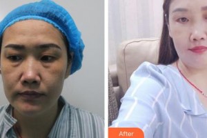 東南大學(xué)附屬中大醫(yī)院整形外科章慶國整形價(jià)格表附外切祛眼袋案例展示