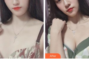 遵義韓美整形美容醫(yī)院王祥整形價(jià)格表附自體脂肪隆胸案例展示