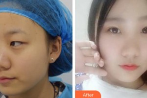 昆明康特森眼科醫(yī)院張風(fēng)整形價(jià)格表附定點(diǎn)雙眼皮案例展示