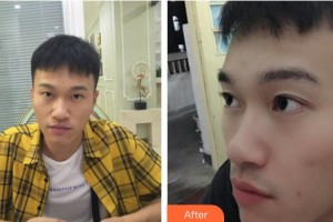 昆明康特森眼科醫(yī)院盧海整形價(jià)格表附下瞼整形案例展示