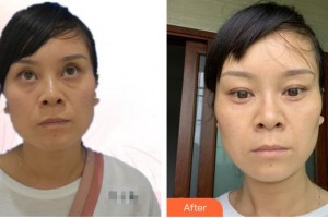 昆明阿瑪施眼科門診部李瑩整形價(jià)格表附激光去眼袋案例展示