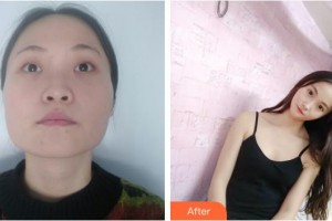 昆明康特森眼科醫(yī)院黎曉新整形價格表附眼部案例展示　