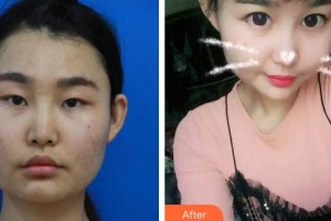 昆明眼科醫(yī)院段智寰整形價格表附切開雙眼皮案例展示