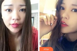 昆明愛爾眼科醫(yī)院張康林整形價格表附切開雙眼皮案例展示