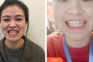 昆明拜博口腔醫(yī)院黃志堅(jiān)整形價(jià)格表附牙齒矯正案例展示　