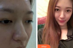 昆明眼科醫(yī)院詹行楷整形價(jià)格表附切開(kāi)雙眼皮案例展示