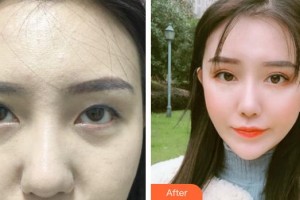 昆明普瑞眼科醫(yī)院羅燕珊整形價格表附眼部綜合案例展示