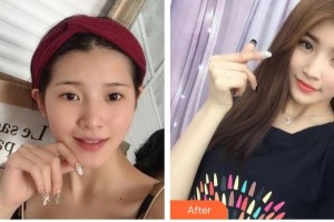 昆明拜博口腔醫(yī)院梁娜整形價(jià)格表附切開(kāi)雙眼皮案例展示