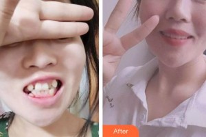 昆明拜博口腔醫(yī)院施建玲整形價(jià)格表附金屬托槽矯正案例展示