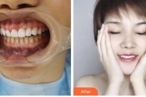 昆明拜博口腔醫(yī)院王爽整形價(jià)格表附美白貼片案例展示