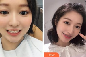 昆明拜博口腔醫(yī)院陳情整形價(jià)格表附金屬托槽矯正案例展示