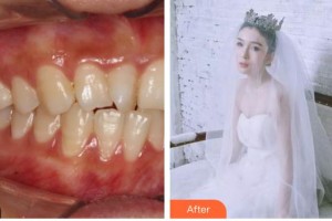 昆明拜博口腔醫(yī)院張琳整形價(jià)格表附牙齒隱形矯正案例展示