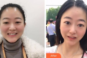 昆明拜博口腔醫(yī)院趙建梅整形價(jià)格表附隱形托槽矯正案例展示