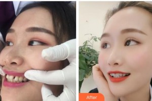 昆明拜博口腔醫(yī)院張馨月整形價(jià)格表附隱形托槽矯正例展示