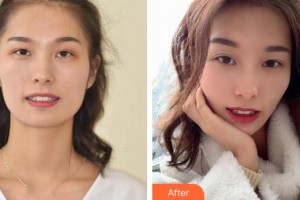 昆明拜博口腔醫(yī)院周莉整形價(jià)格表附牙齒隱形矯正案例展示