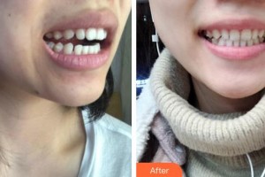 昆明拜博口腔醫(yī)院張強(qiáng)整形價(jià)格表附牙齒隱形矯正案例展示