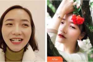 昆明拜博口腔醫(yī)院張丹丹整形價(jià)格表附牙齒隱形矯正案例展示