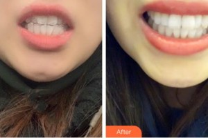 昆明美立方（原大華）醫(yī)療美容醫(yī)院亞明宏整形價(jià)格表附牙齒隱形矯正案例展示