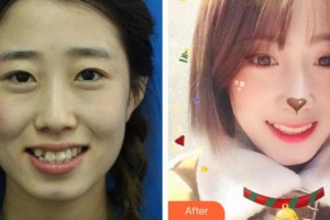 整形醫(yī)院童曉昕整形價(jià)格表附牙齒隱形矯正案例展示