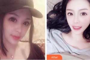 昆明吳氏嘉美美容醫(yī)院楊正梅整形價(jià)格表附金屬托槽矯正案例展示