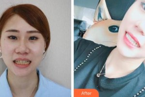 昆明醫(yī)科大學(xué)附屬口腔醫(yī)院億大口腔門診部劉娟整形價(jià)格表附超聲波潔牙案例展示