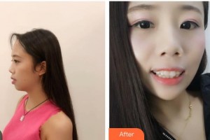 昆明愛齊口腔門診部蘇建輝整形價(jià)格表附金屬托槽矯正案例展示