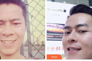 昆明愛(ài)雅仕口腔醫(yī)院趙雪菲整形價(jià)格表附金屬托槽矯正案例展示