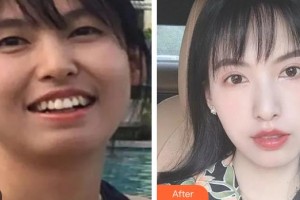 昆明尚愛(ài)韓美口腔門診部李滿坡整形價(jià)格表附牙齒隱形矯正案例展示